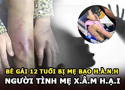 Bé gái 12 tuổi nghi bị mẹ bạo hành, người tình của mẹ xâm hại nhiều lần