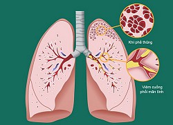 Hướng điều trị mới cho các bệnh viêm đường hô hấp mạn tính