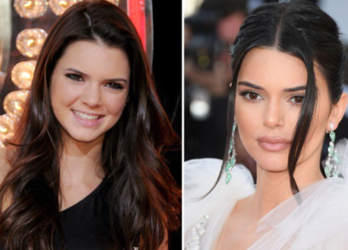 Loạt phẫu thuật thẩm mỹ Kendall Jenner từng thực hiện