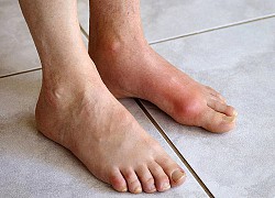 Ca bệnh gout, gan nhiễm mỡ tăng cao sau Tết