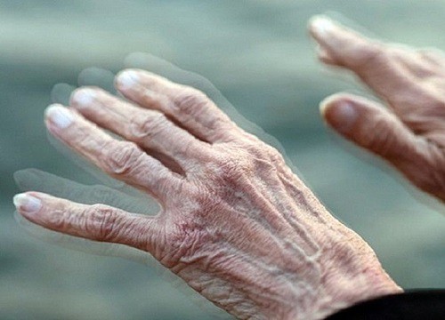 Dấu hiệu sớm bệnh Parkinson