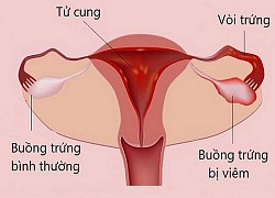 Tìm hiểu về bệnh viêm buồng trứng do biến chứng của quai bị