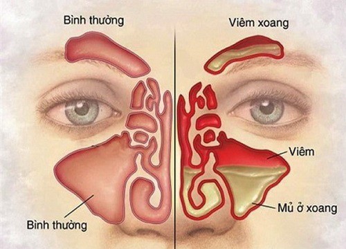 Dùng thuốc khi bị viêm mũi xoang