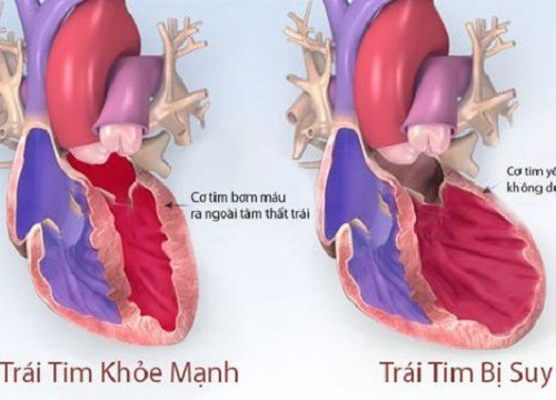 Thuốc ức chế SGLT2 dapagliflozin làm giảm các biến cố suy tim