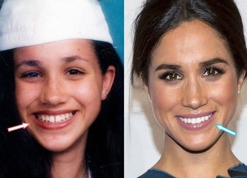 Meghan Markle bị nghi sửa mũi, niềng răng