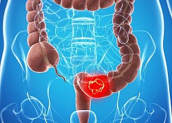 Ung thư đại trực tràng: Những ai cần sàng lọc sớm?
