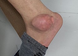 Chữa bệnh gout bằng thuốc trên mạng, người đàn ông bị nổi u to bằng quả ổi