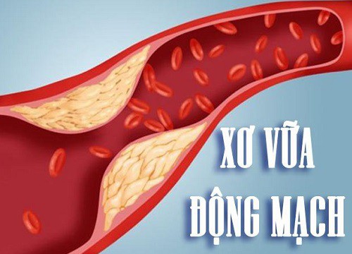 Phát hiện protein có vai trò quan trọng trong chứng xơ vữa động mạch