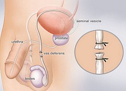 Thắt ống dẫn tinh - Biện pháp tránh thai hiệu quả, ít rủi ro