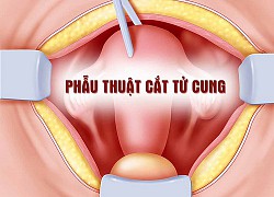 Bất thường chửa trứng ở tuổi 50, 1 phụ nữ phải cắt tử cung