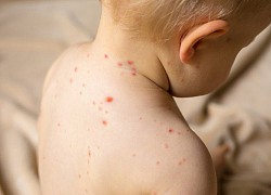 Bệnh Rubella bao lâu thì khỏi?