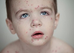 Rubella bị sưng hạch: Sưng hạch do bệnh Rubella có nguy hiểm không?