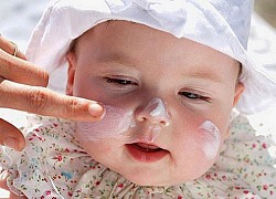 Lo lắng thường gặp khi trẻ bị eczema