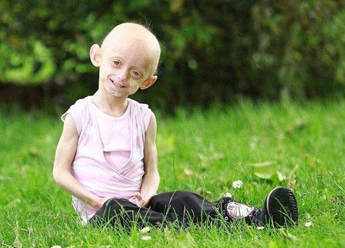 Hội chứng Progeria: Giải mã bí ẩn của những đứa trẻ "già sớm"