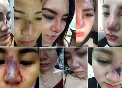 Làm đẹp bằng filler: Cẩn trọng thương tật vĩnh viễn