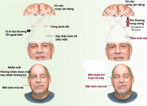 Liệt mặt - nguyên nhân do đâu?