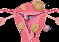 Phát hiện 3 khối u trong tử cung bệnh nhân cao tuổi