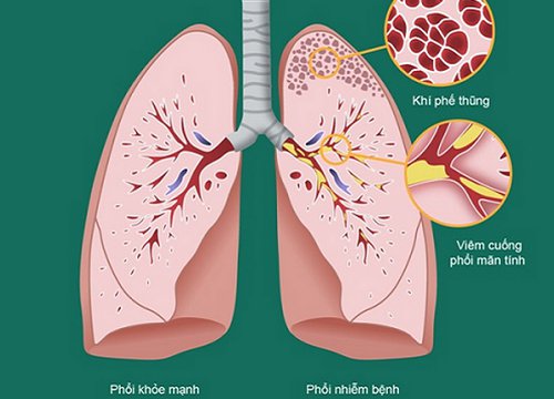 Tìm ra căn nguyên gây bệnh viêm đường hô hấp mạn tính