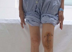 Lần đầu tiên ở Việt Nam mổ thay khớp gối cho bệnh nhân lao khớp