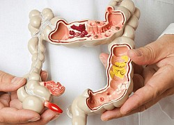 Trĩ ngoại có nguy cơ chuyển sang ung thư?