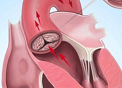 Biến chứng nguy hiểm của vôi hóa van tim