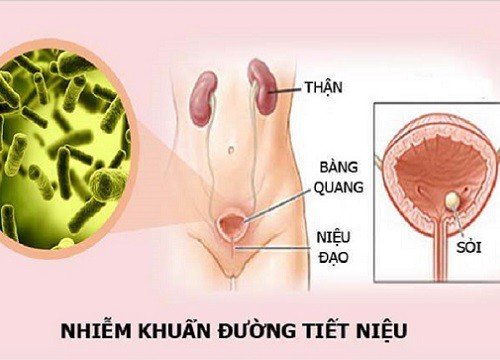 Nhận biết, phòng ngừa nhiễm trùng tiết niệu