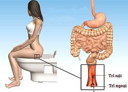 16 tuổi đã trĩ nặng chỉ vì thói quen xấu đang diễn ra với bất kỳ ai hiện nay