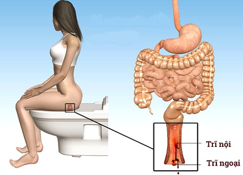 16 tuổi đã trĩ nặng chỉ vì thói quen xấu đang diễn ra với bất kỳ ai hiện nay