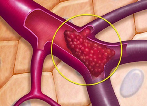 Cách phát hiện "kẻ thù nguy hiểm"- Cục máu đông