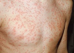 Chẩn đoán và xử lý kịp thời khi bị sốt phát ban do bệnh Rubella