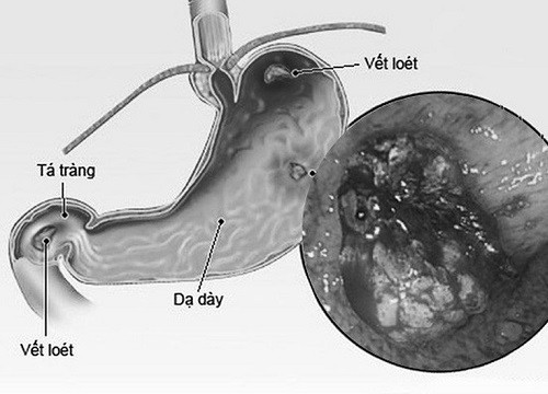 Phụ thuộc corticoid - bài học đắt giá