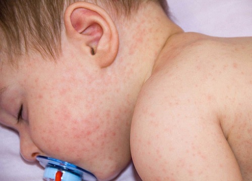 Rubella: Tìm hiểu nguyên nhân gây hội chứng Rubella bẩm sinh