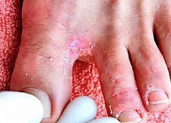 Cách trị nấm kẽ chân