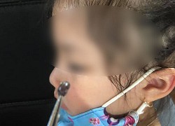 Đau tai nhiều ngày không khỏi, bé gái đi khám được bác sĩ gắp ra một con ve chó "hút máu no căng", các gia đình nuôi chó cần hết sức lưu tâm
