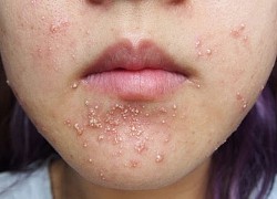 Mặt nổi mụn chi chít, mưng mủ vì sử dụng kem chống nắng tự chế