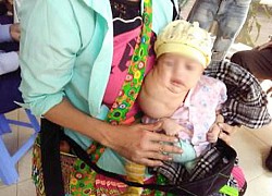 Phẫu thuật khối u bạch huyết khổng lồ cho bé trai mới 1 tháng tuổi