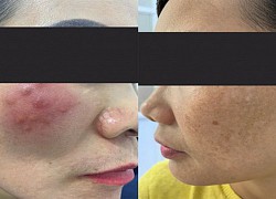 Tai biến do trị nám không an toàn