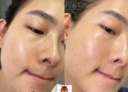 Tự peel da tại nhà, cô nàng này bị ngứa râm ran nhưng kết quả nhận được là làn da căng bóng mỹ mãn