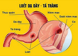 Dấu hiệu viêm loét dạ dày, tá tràng