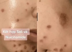 Tranh cãi việc kết hợp BHA & Niacinamide: Chuyên gia giải thích cặn kẽ và đưa ra cách dùng thật hợp lý