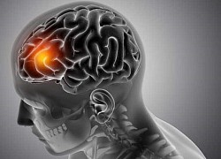 Alzheimer làm tăng nguy cơ mắc COVID-19 nghiêm trọng và tử vong