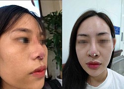 &#8220;Dao kéo&#8221; hỏng: Nỗi khổ của bệnh nhân và cái khó của bác sĩ