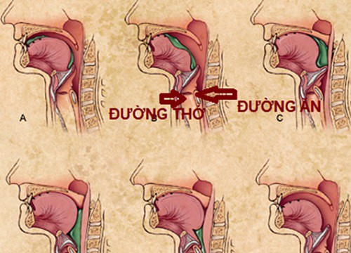 Có thể bạn đã bị rối loạn chức năng nuốt mà không biết!