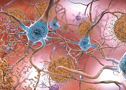 Mục tiêu điều trị mới tiềm năng cho bệnh Alzheimer