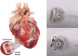 Máy tạo nhịp tim tạm thời tự hủy đầu tiên trên thế giới