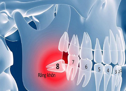 Nhổ răng khôn có thể cải thiện vị giác của bạn?