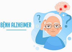 Người trẻ có dễ bị Alzheimer?