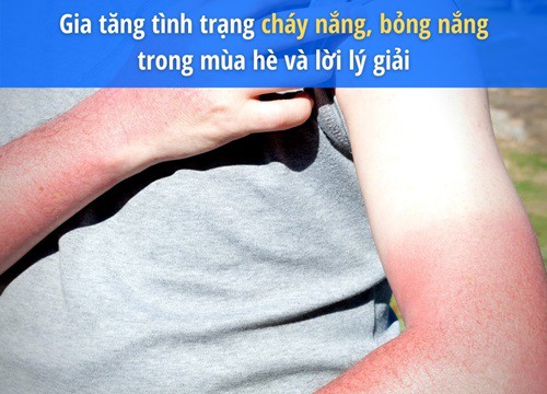 Gia tăng tình trạng cháy nắng, bỏng nắng trong mùa hè và lời lý giải từ bác sĩ