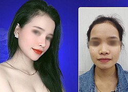 Nâng mũi, nên chọn phẫu thuật hay tiêm filler?