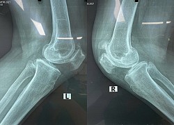Tổn thương xương bánh chè hai mảnh hiếm gặp